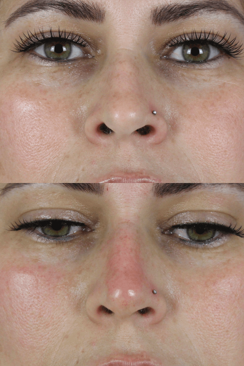 Liquid Rhinoplasty Patient Results