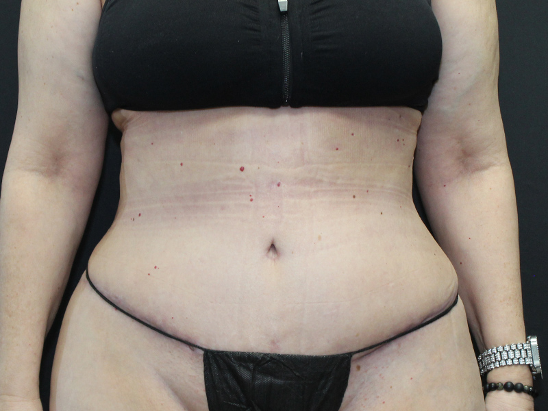 Case--5877 | After Abdominoplasty 1