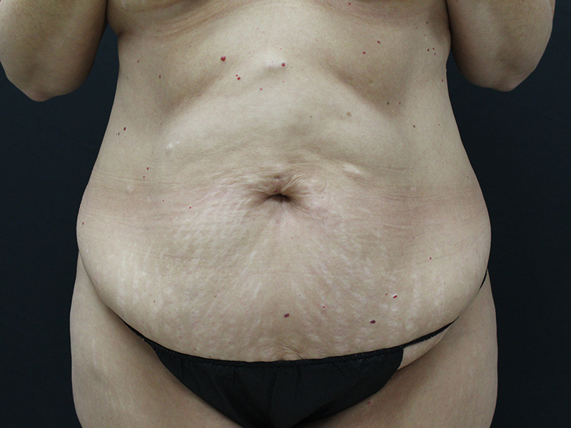 Case--5877 | Before Abdominoplasty 1
