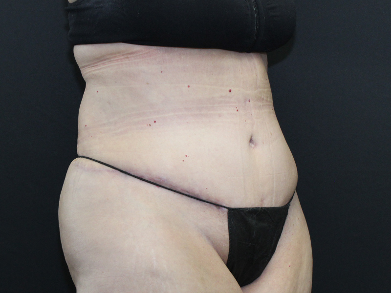 Case--5877 | After Abdominoplasty 2