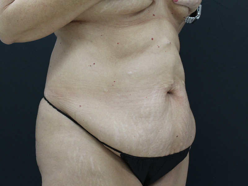 Case--5877 | Before Abdominoplasty 2
