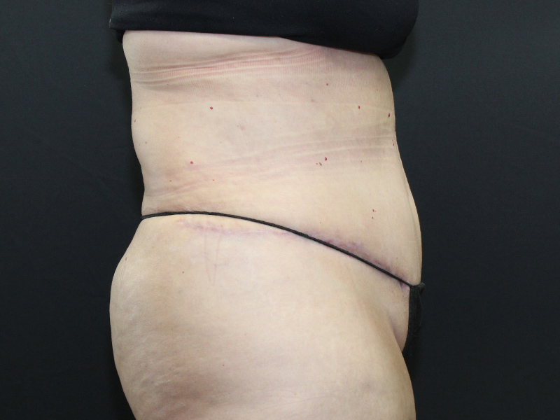 Case--5877 | After Abdominoplasty 3