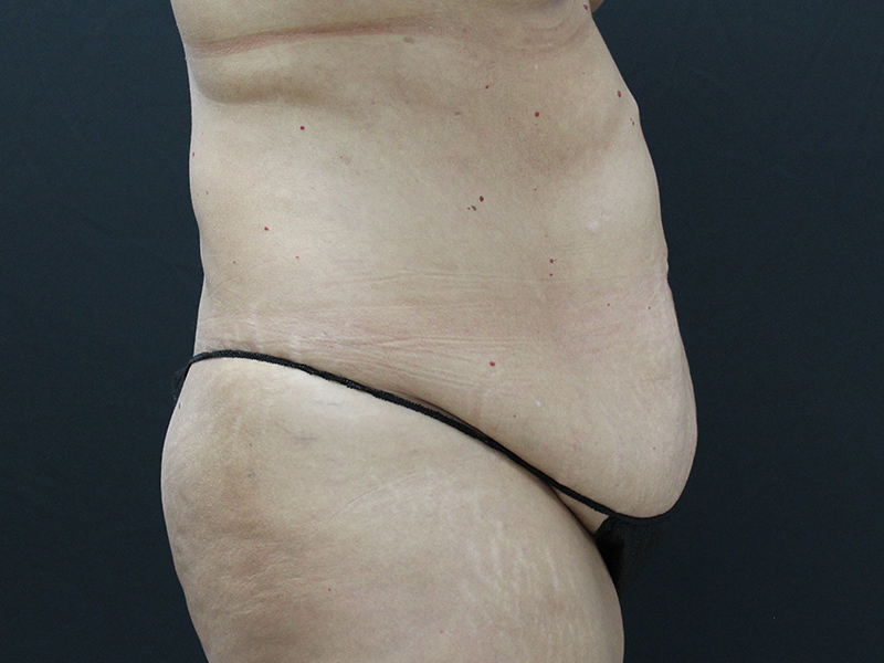 Case--5877 | Before Abdominoplasty 3
