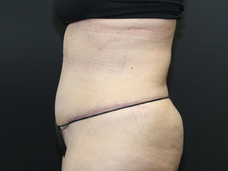 Case--5877 | After Abdominoplasty 4
