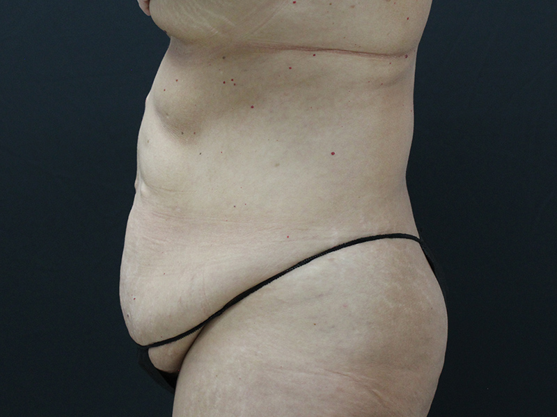 Case--5877 | Before Abdominoplasty 4