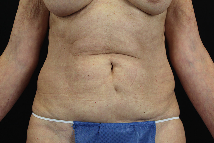Case--3598 | Before Abdominoplasty 1