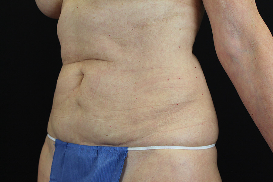 Case--3598 | Before Abdominoplasty 5