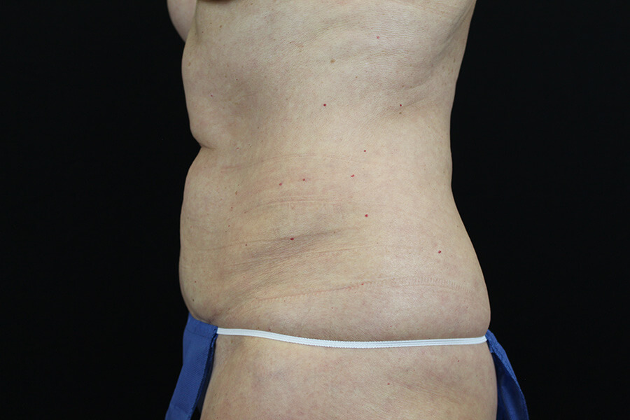 Case--3598 | Before Abdominoplasty 4
