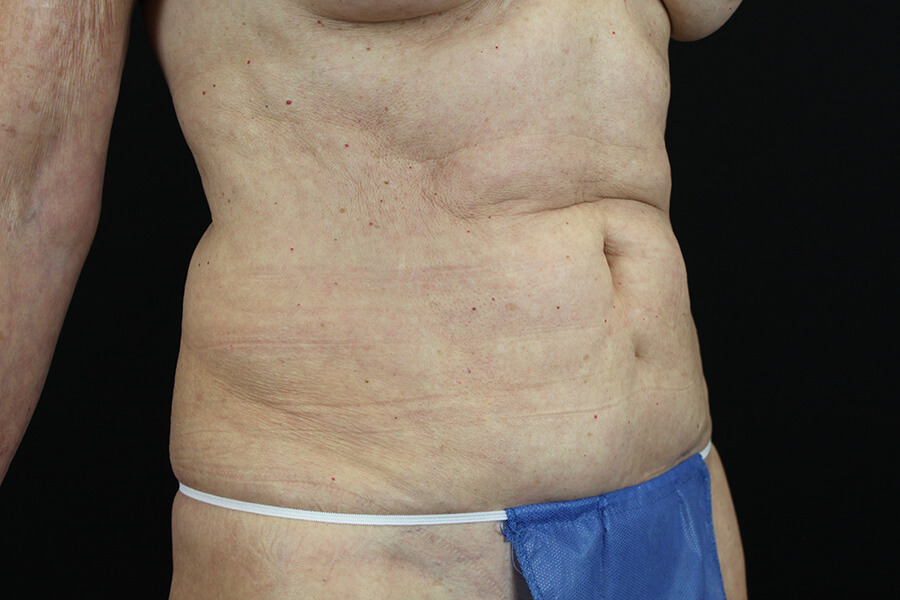 Case--3598 | Before Abdominoplasty 3