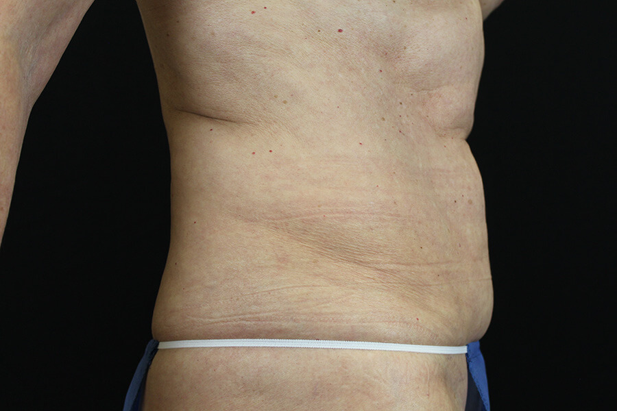 Case--3598 | Before Abdominoplasty 2