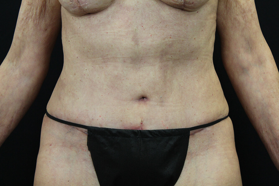 Case--3598 | After Abdominoplasty 1