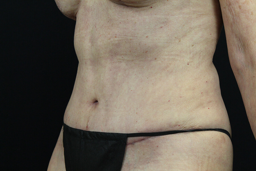 Case--3598 | After Abdominoplasty 5