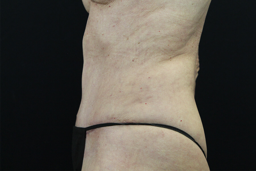 Case--3598 | After Abdominoplasty 4