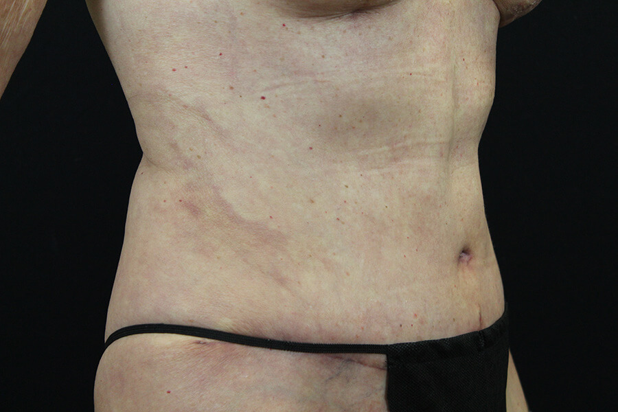 Case--3598 | After Abdominoplasty 3