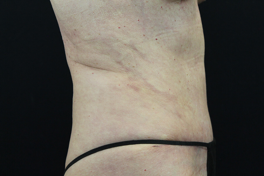 Case--3598 | After Abdominoplasty 2