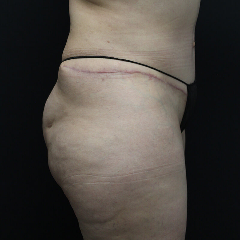 Case--1983 | Before BBL 3