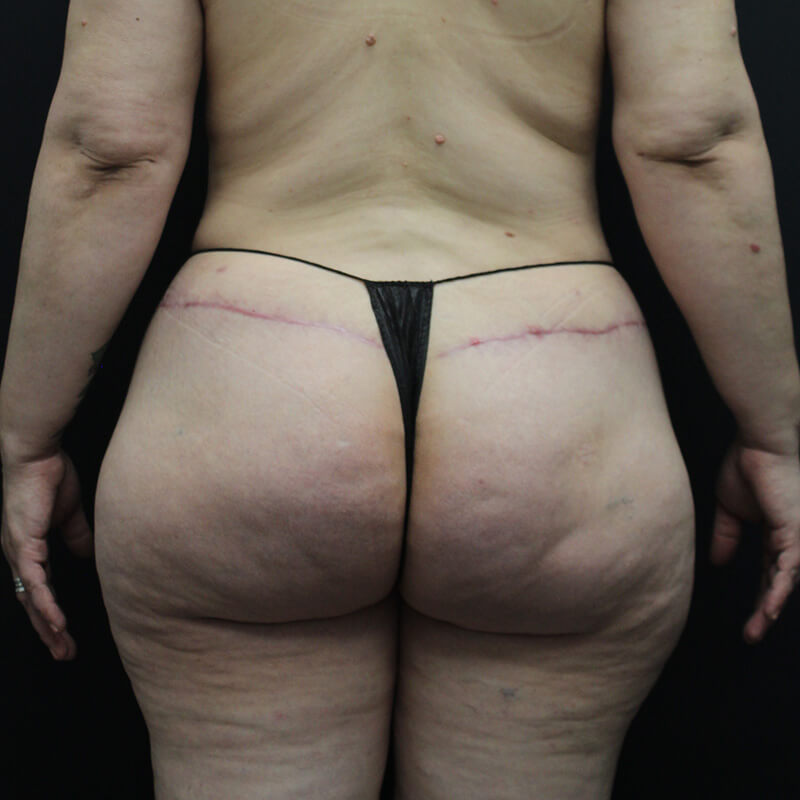 Case--1983 | After BBL 1