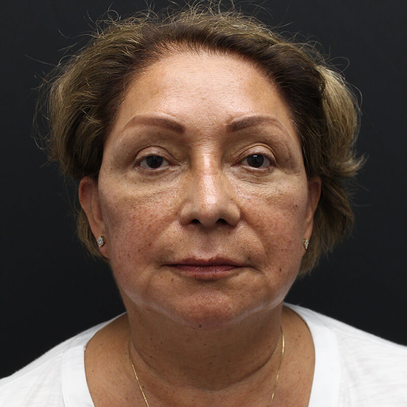 Case--6552 | Before Neck Lift 1