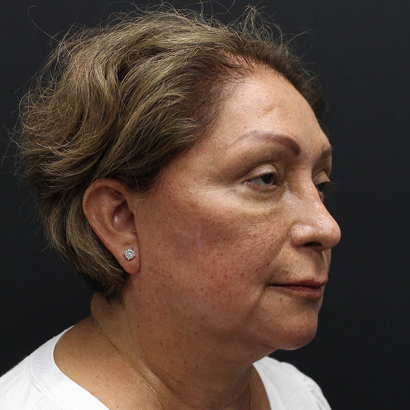 Case--6552 | Before Neck Lift 2