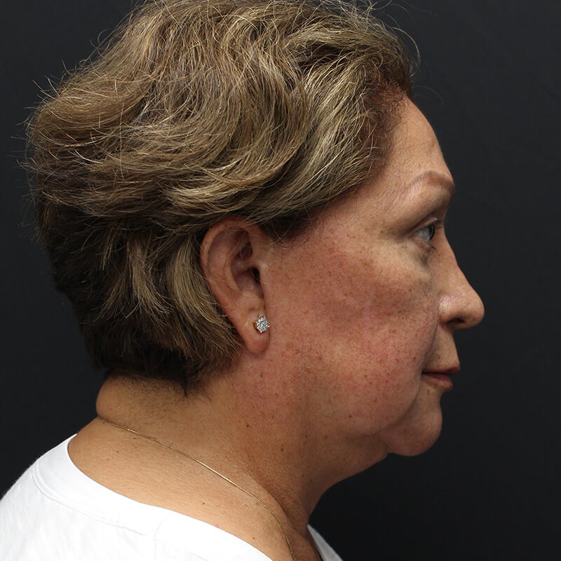 Case--6552 | Before Neck Lift 3