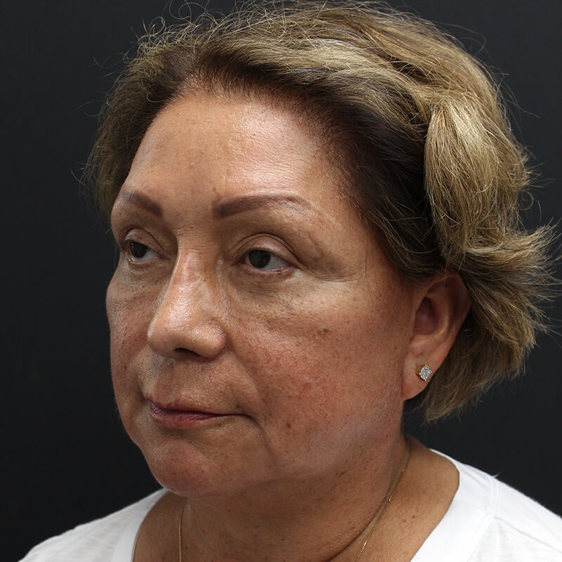 Case--6552 | Before Neck Lift 4