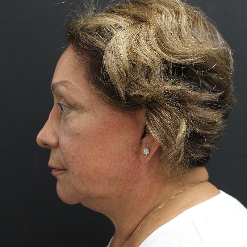 Case--6552 | Before Neck Lift 5