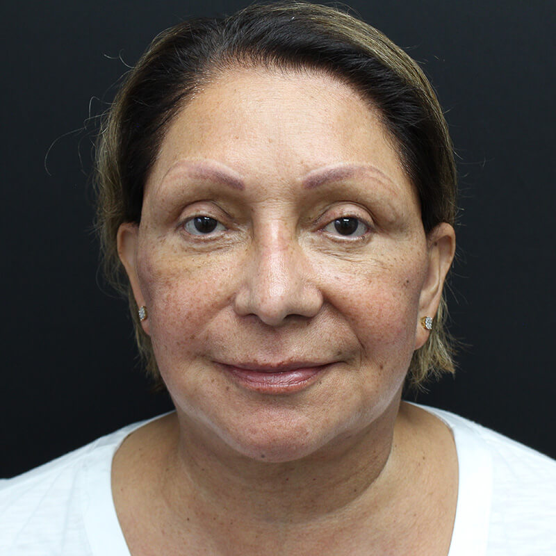 Case--6552 | After Neck Lift 1