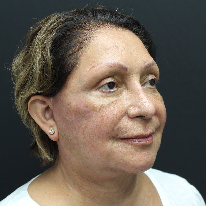 Case--6552 | After Neck Lift 2