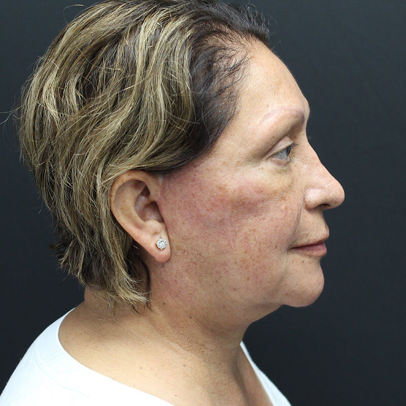 Case--6552 | After Neck Lift 3