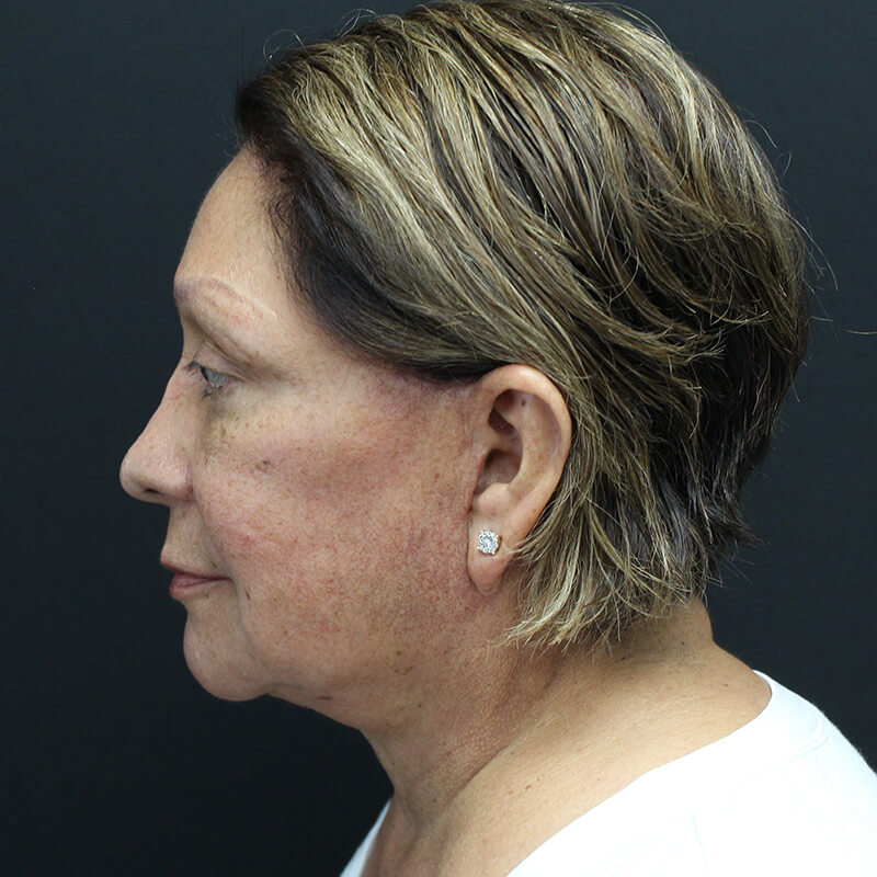 Case--6552 | After Neck Lift 5