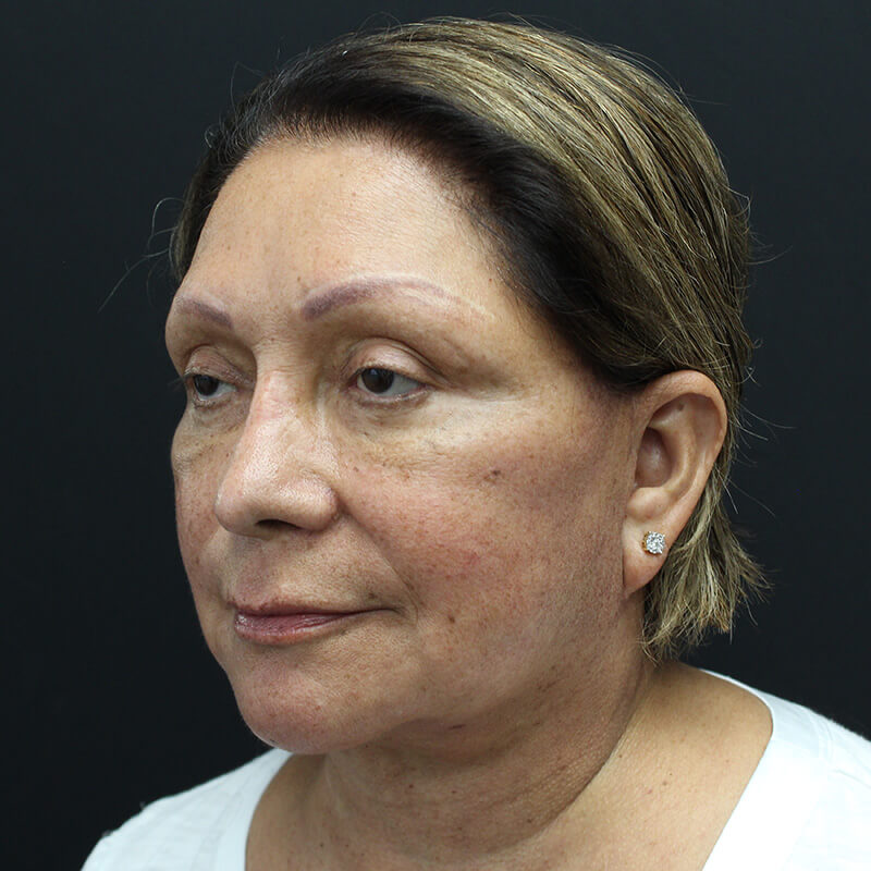 Case--6552 | After Neck Lift 4