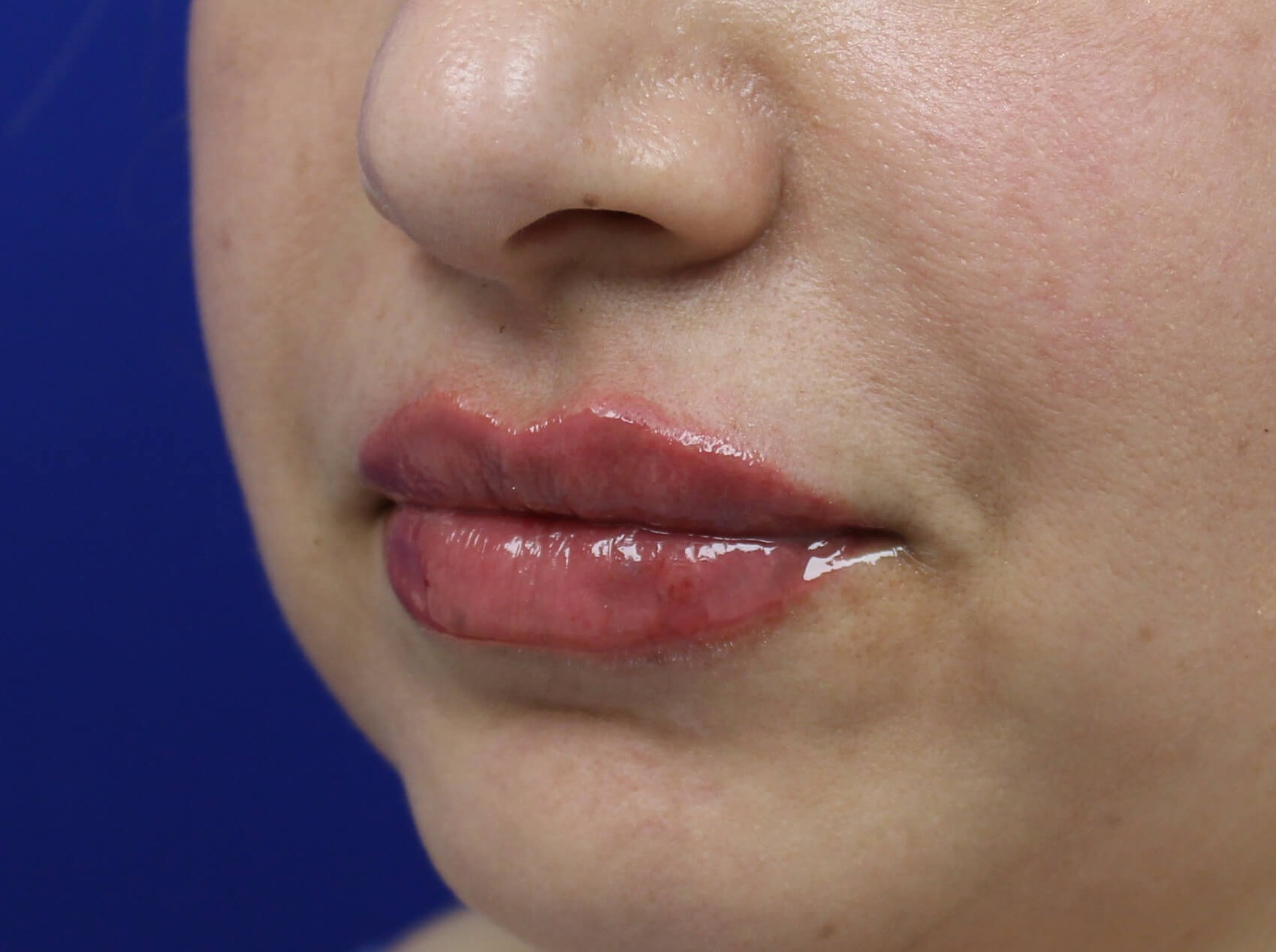 Case--4149 | After Face 5