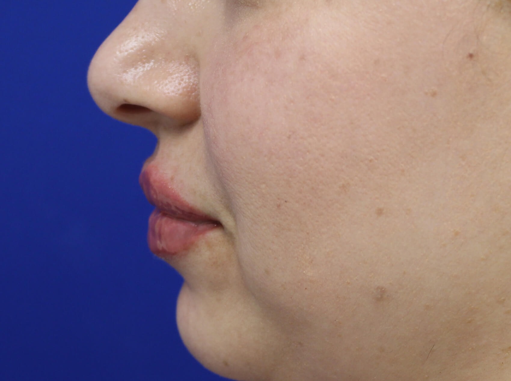 Case--4149 | After Face 4