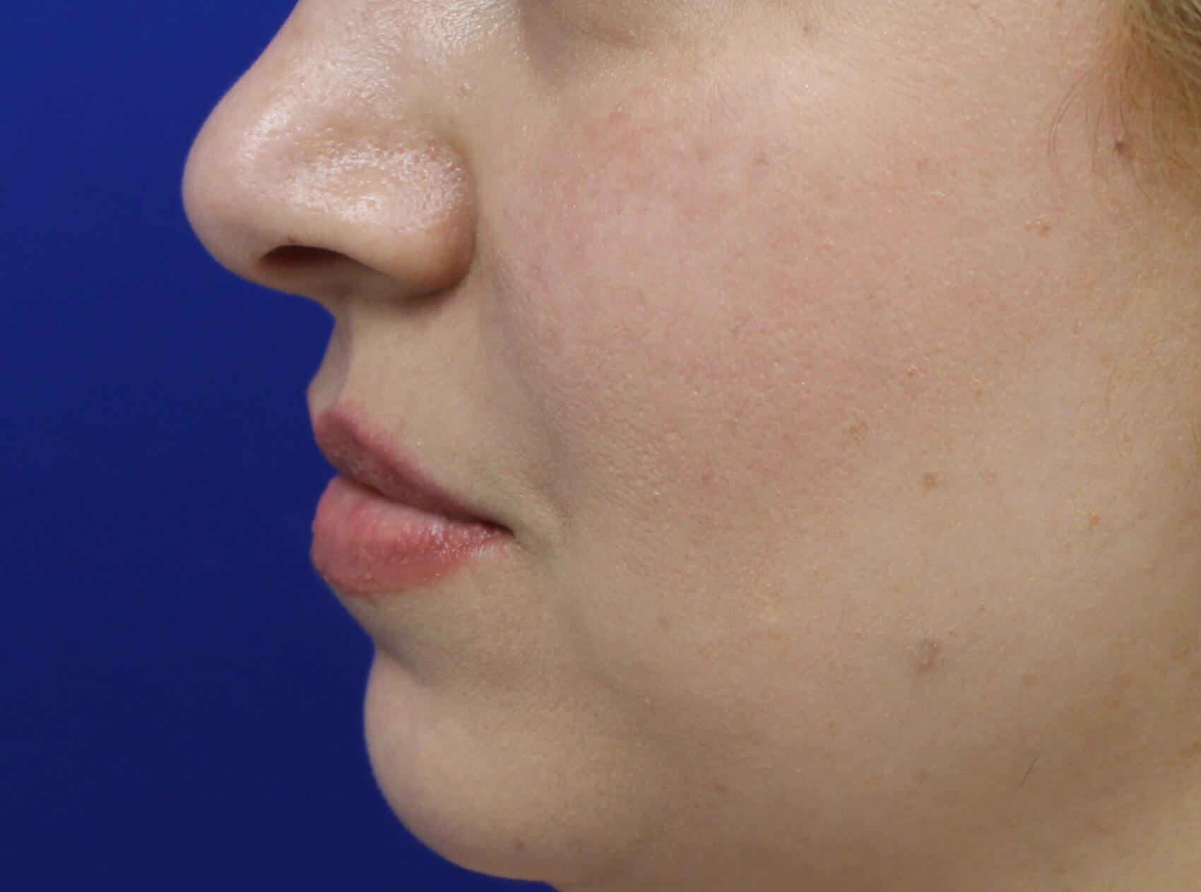 Case--4149 | Before Face 4