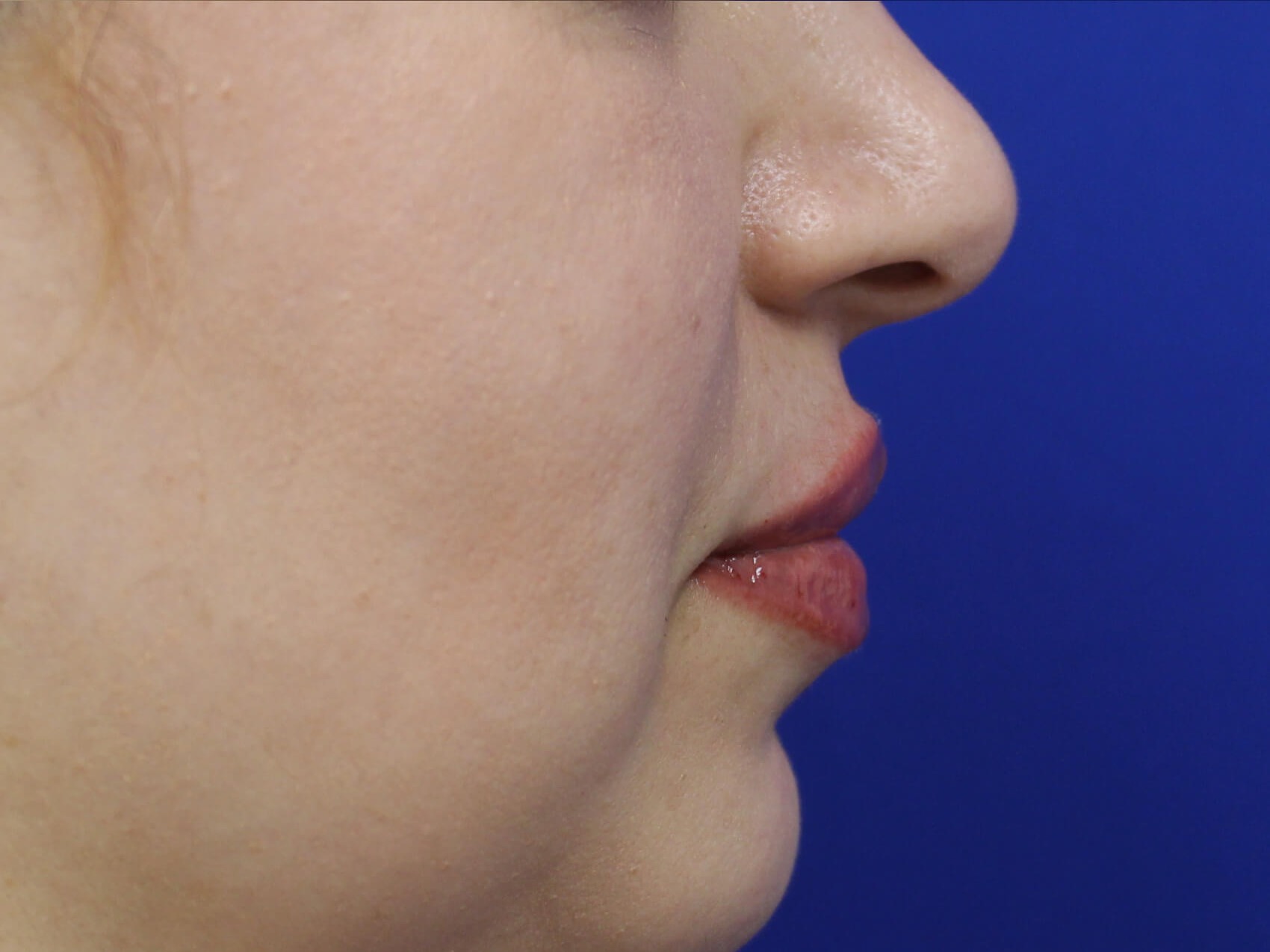 Case--4149 | After Face 3