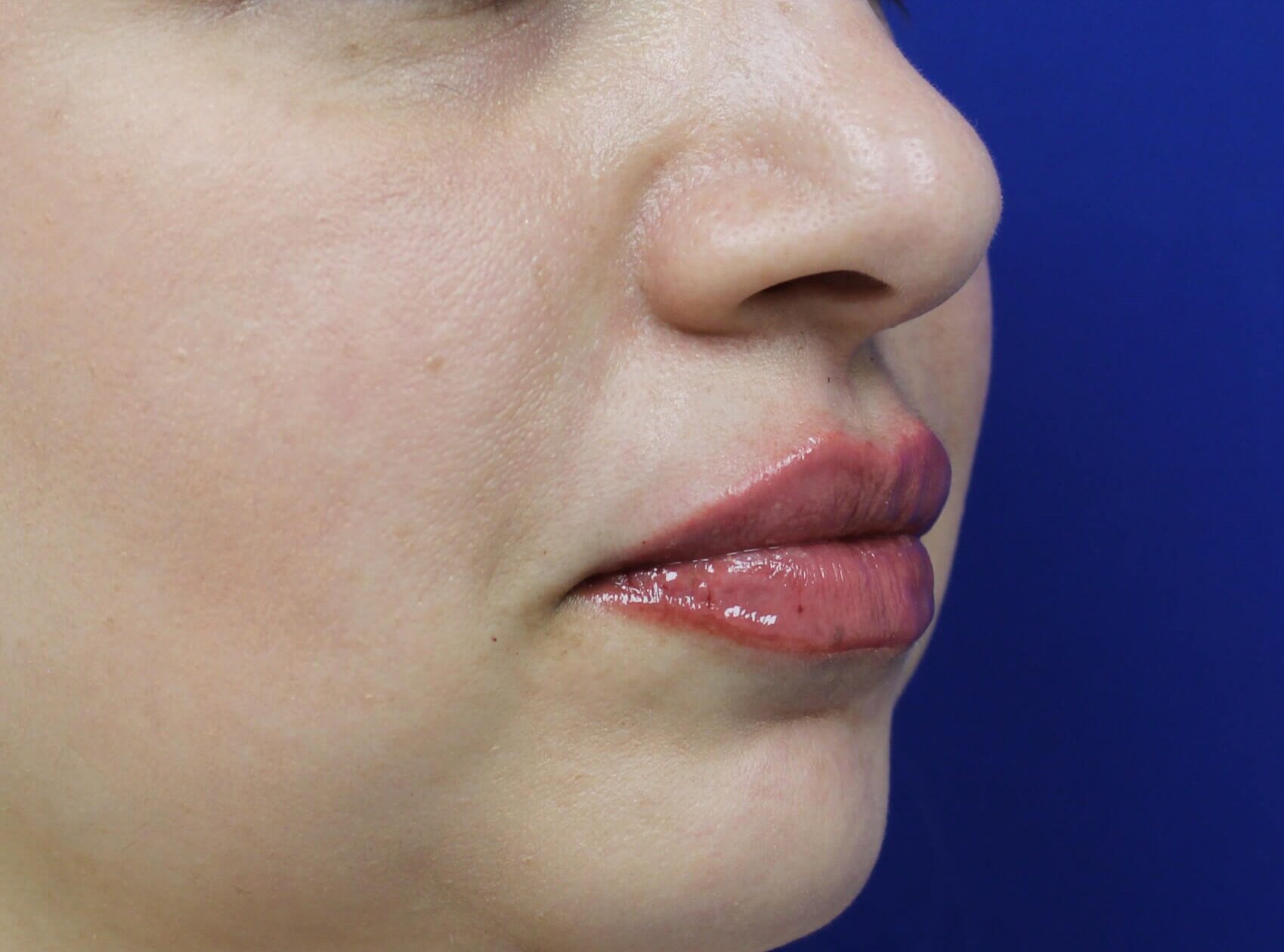 Case--4149 | After Face 2