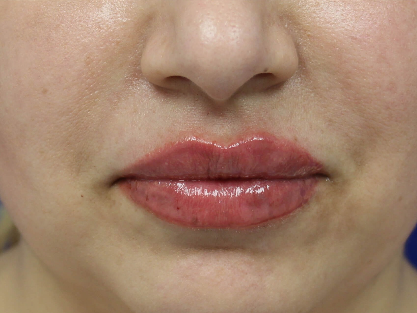 Case--4149 | After Face 1