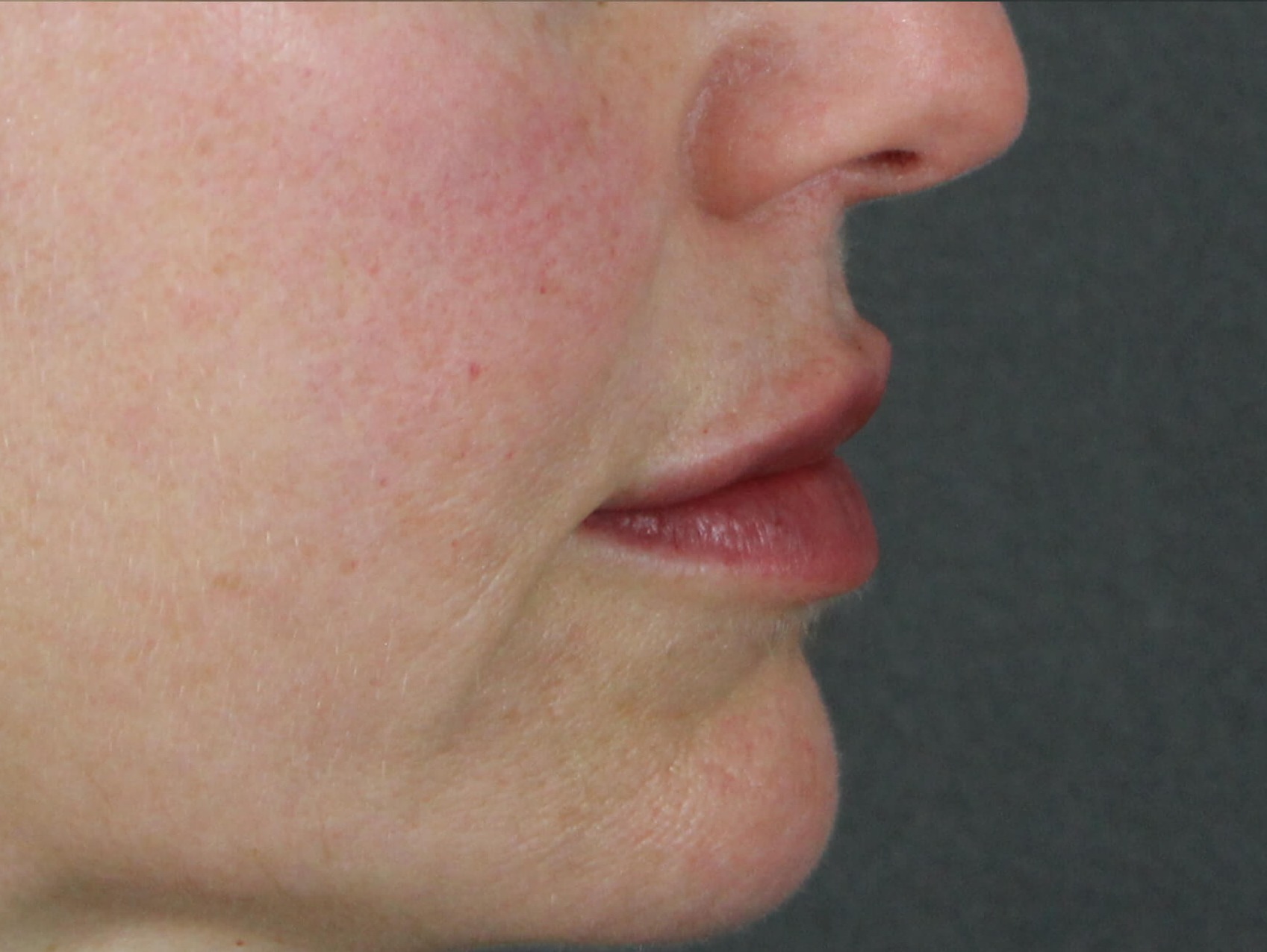 Case--7928 | After Face 3