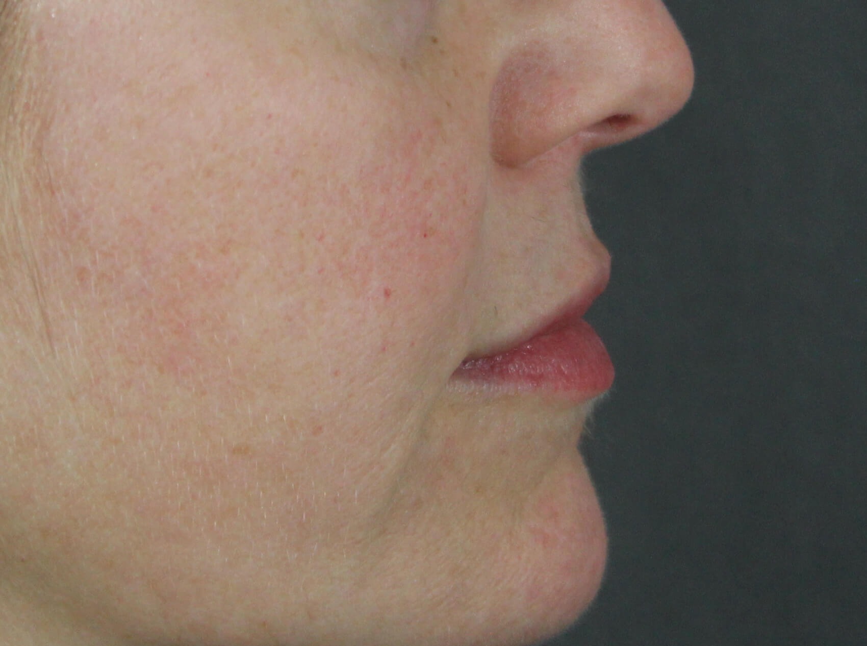 Case--7928 | Before Face 3