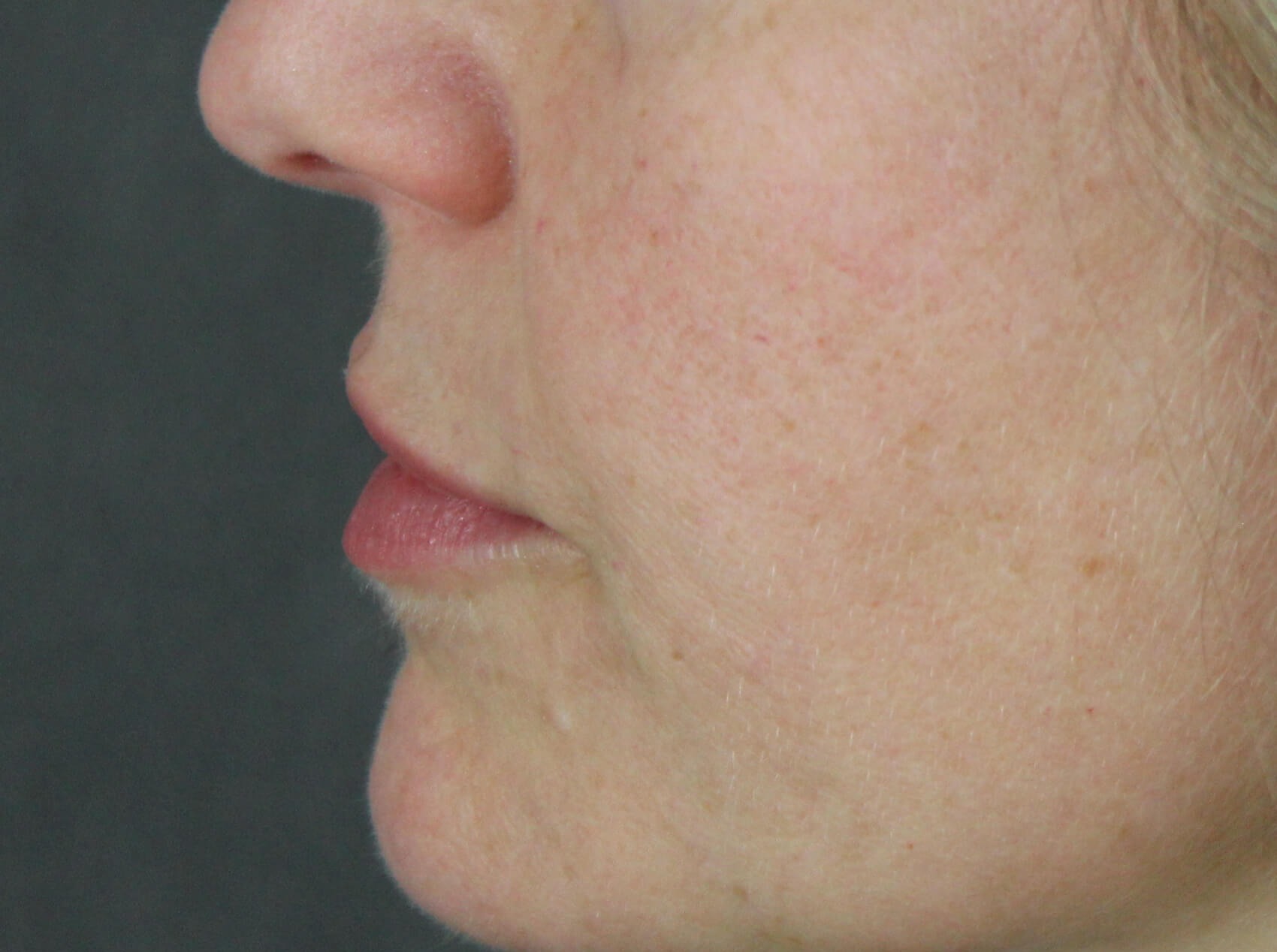 Case--7928 | Before Face 2