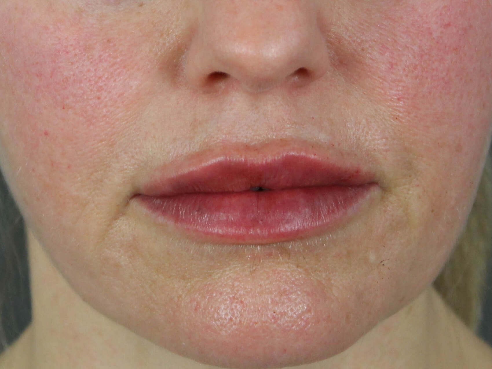 Case--7928 | After Face 1