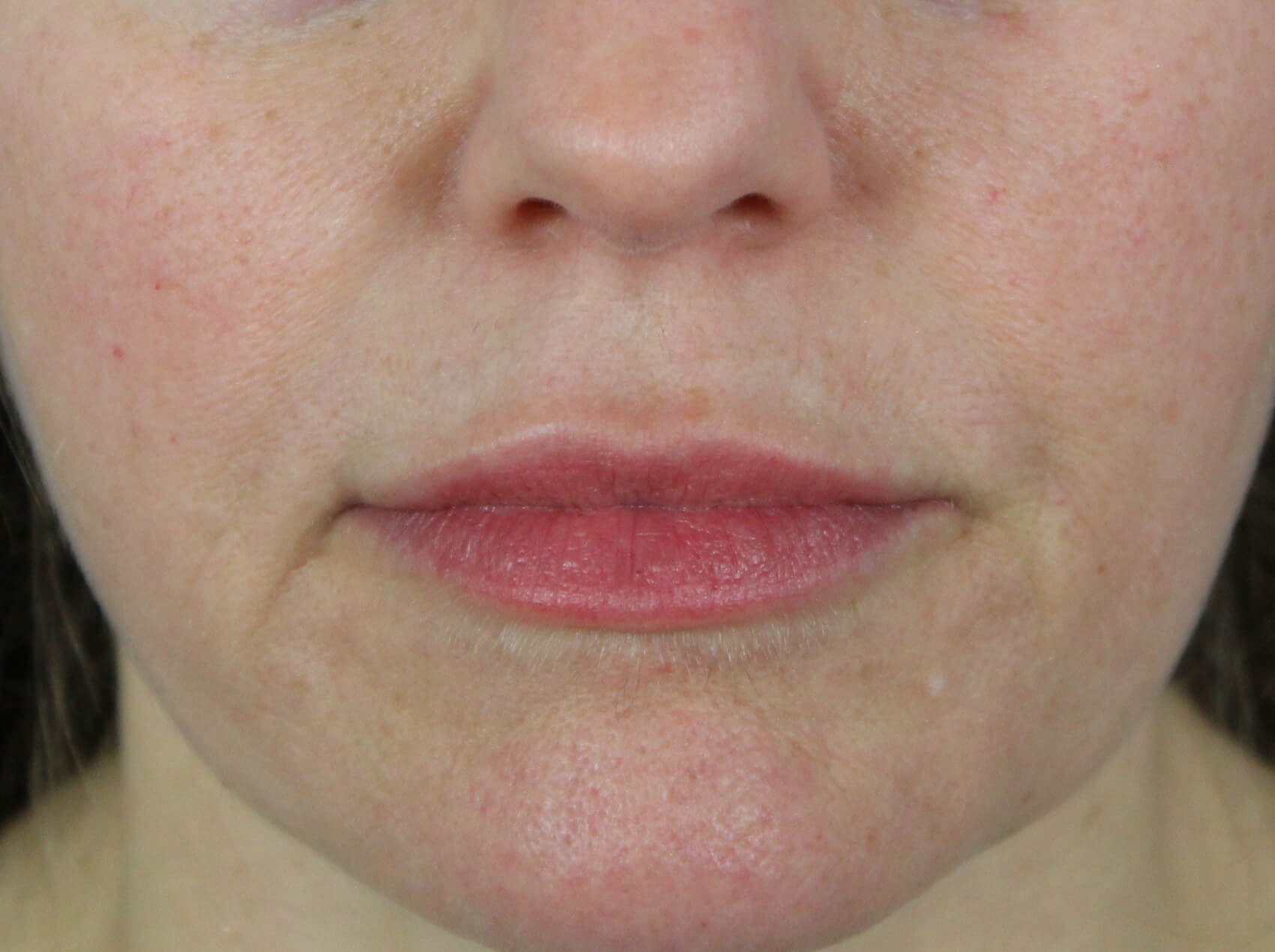 Case--7928 | Before Face 1