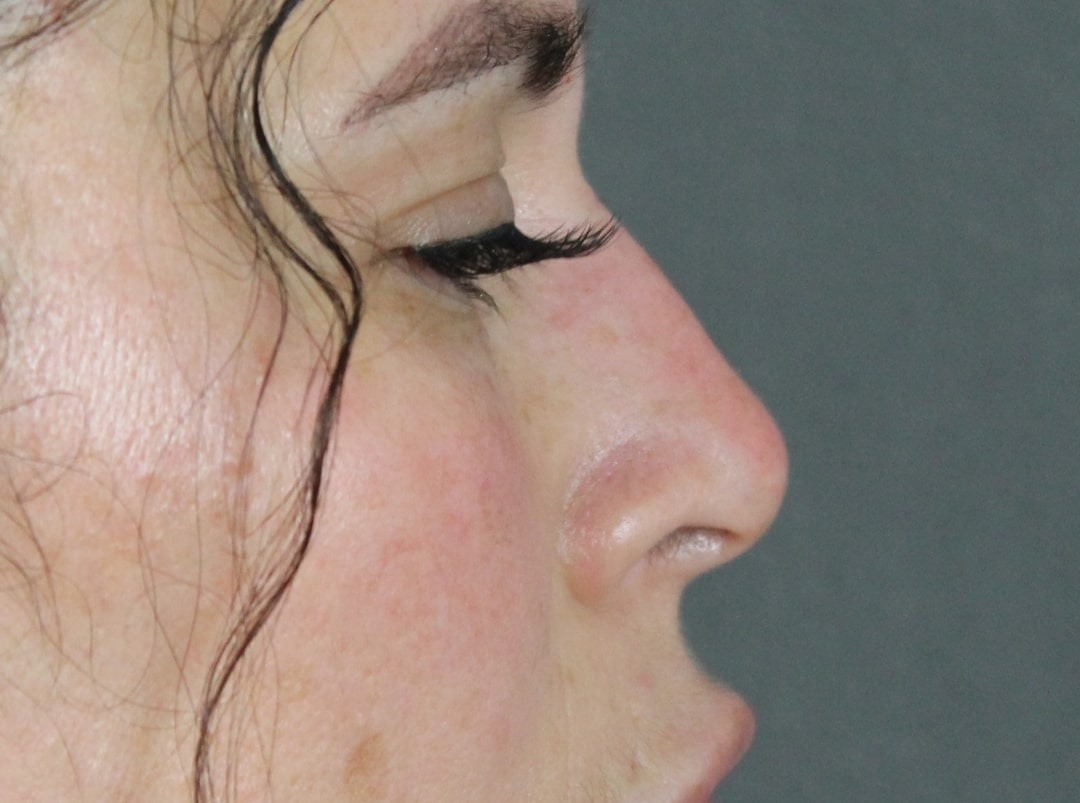 Case--6313 | After Face 3