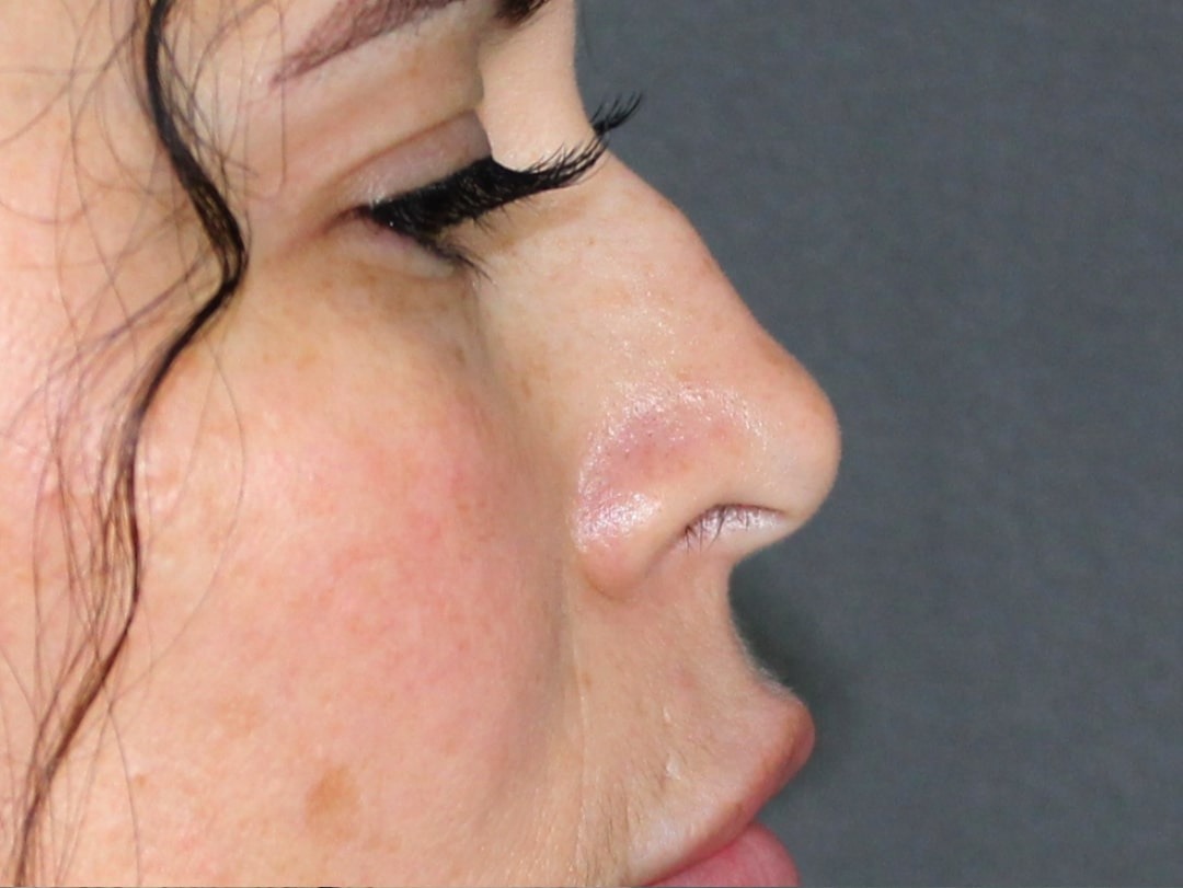 Case--6313 | Before Face 3