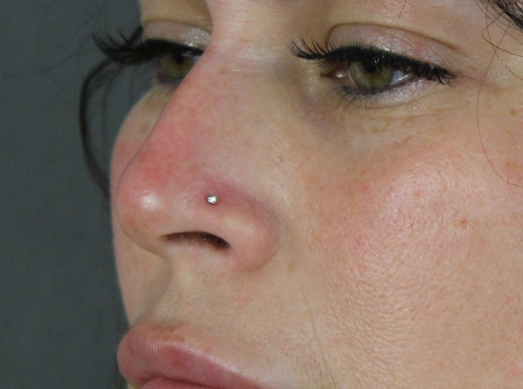 Case--6313 | After Face 2