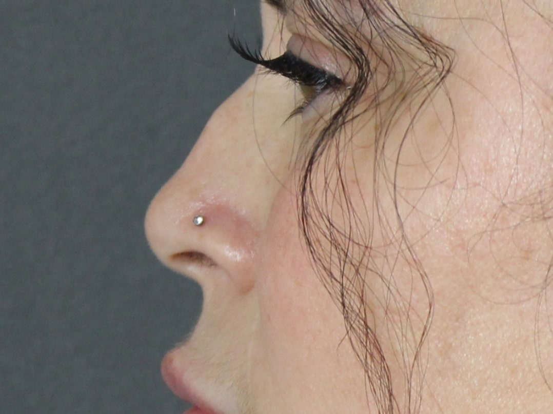 Case--6313 | Before Face 2