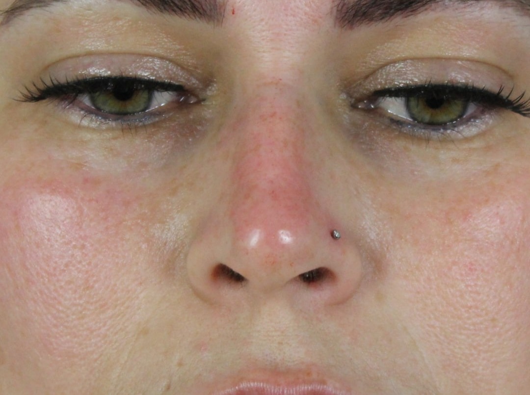 Case--6313 | After Face 1