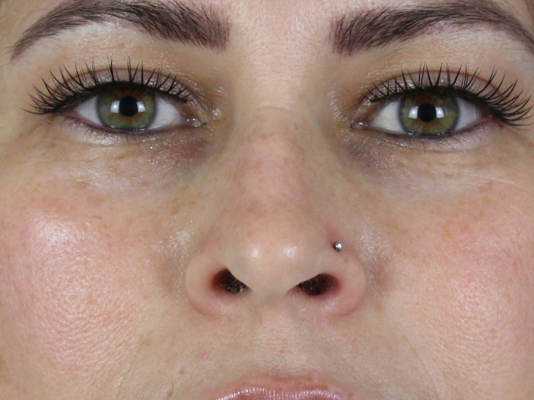 Case--6313 | Before Face 1