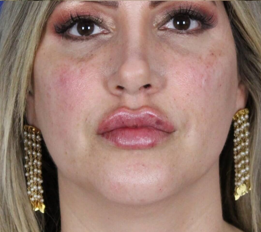 Case--6897 | After Face 1