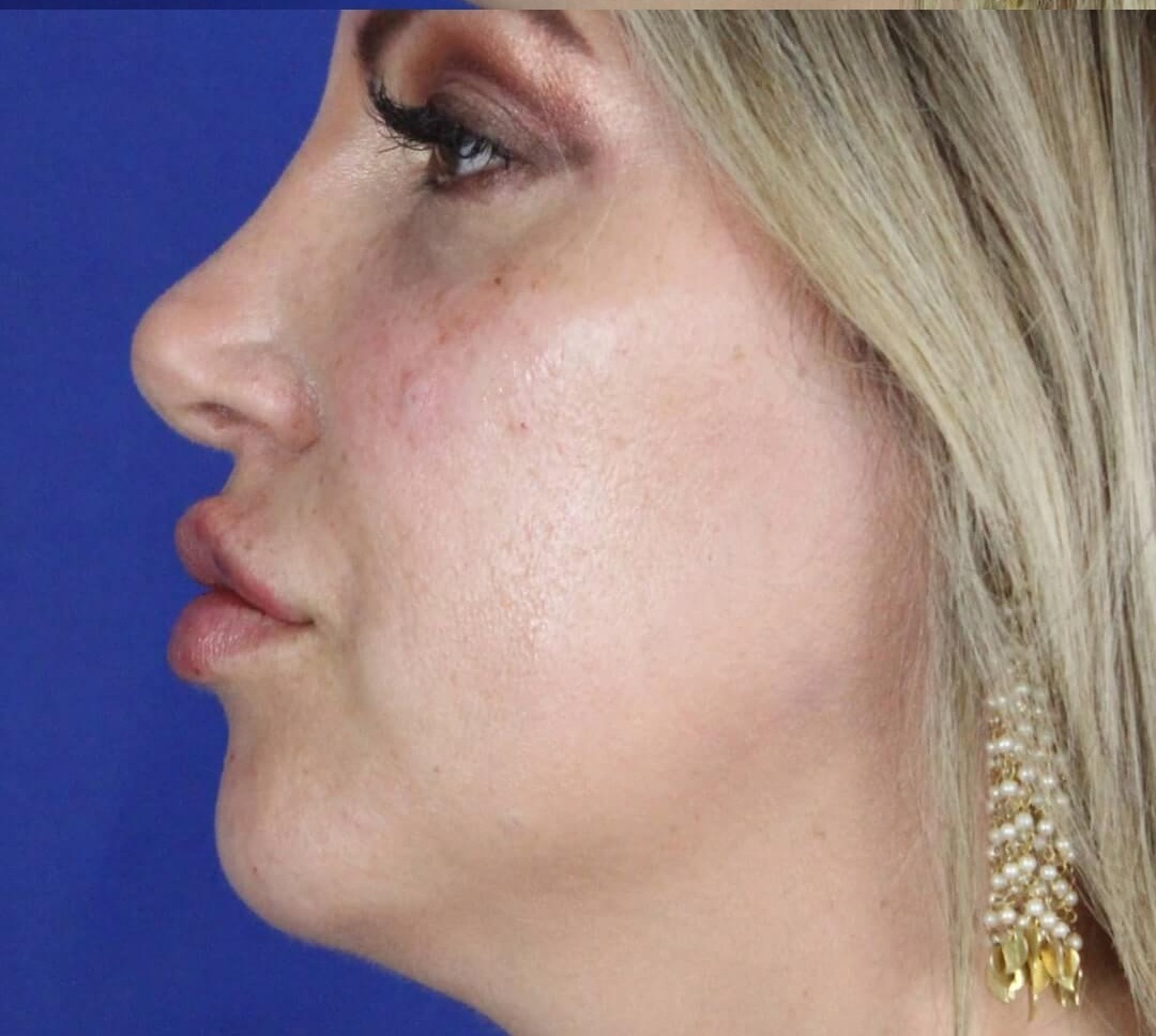 Case--6897 | After Face 3